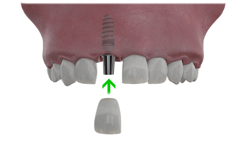 Das eingesetzte Implantat mit der neuen Zahnkrone 