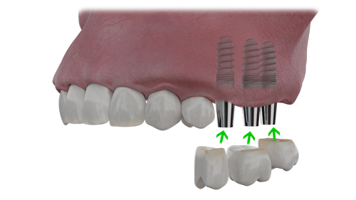 Drei Einzelzähne auf drei Implantaten